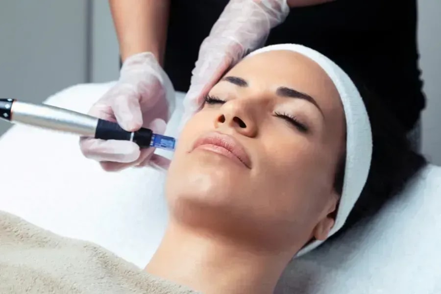 Microneedling in Nürnberg zur Verbesserung von Narben und Fältchen