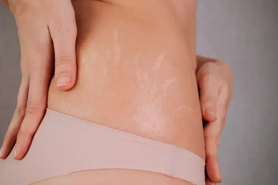 Dehnungsstreifen und Narben verbessern mit Microneedling-Therapie